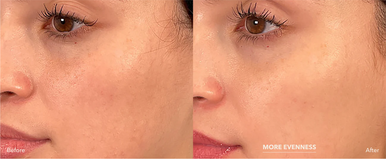 Before and after xomd2